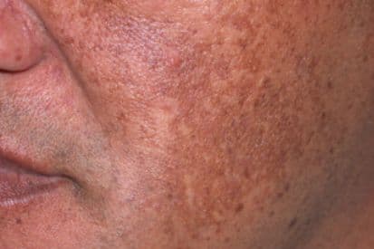 Melasma-example-on-cheeks