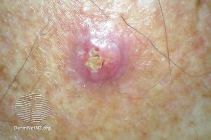 pinnacleskin.com /conditions/skin-cancer Carousel 1 Image 5