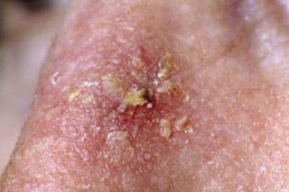 actinic-keratosis-on-nose